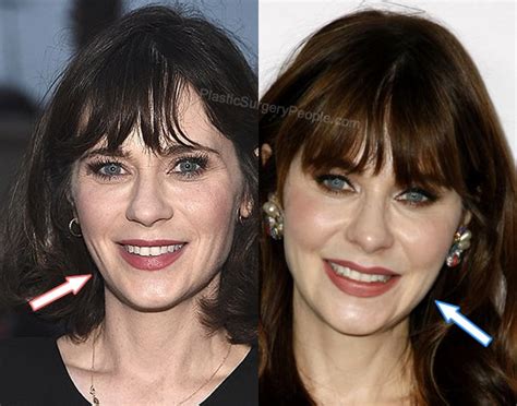 zooey deschanel facelift|Zooey Deschanel Plastic Surgery Before & After